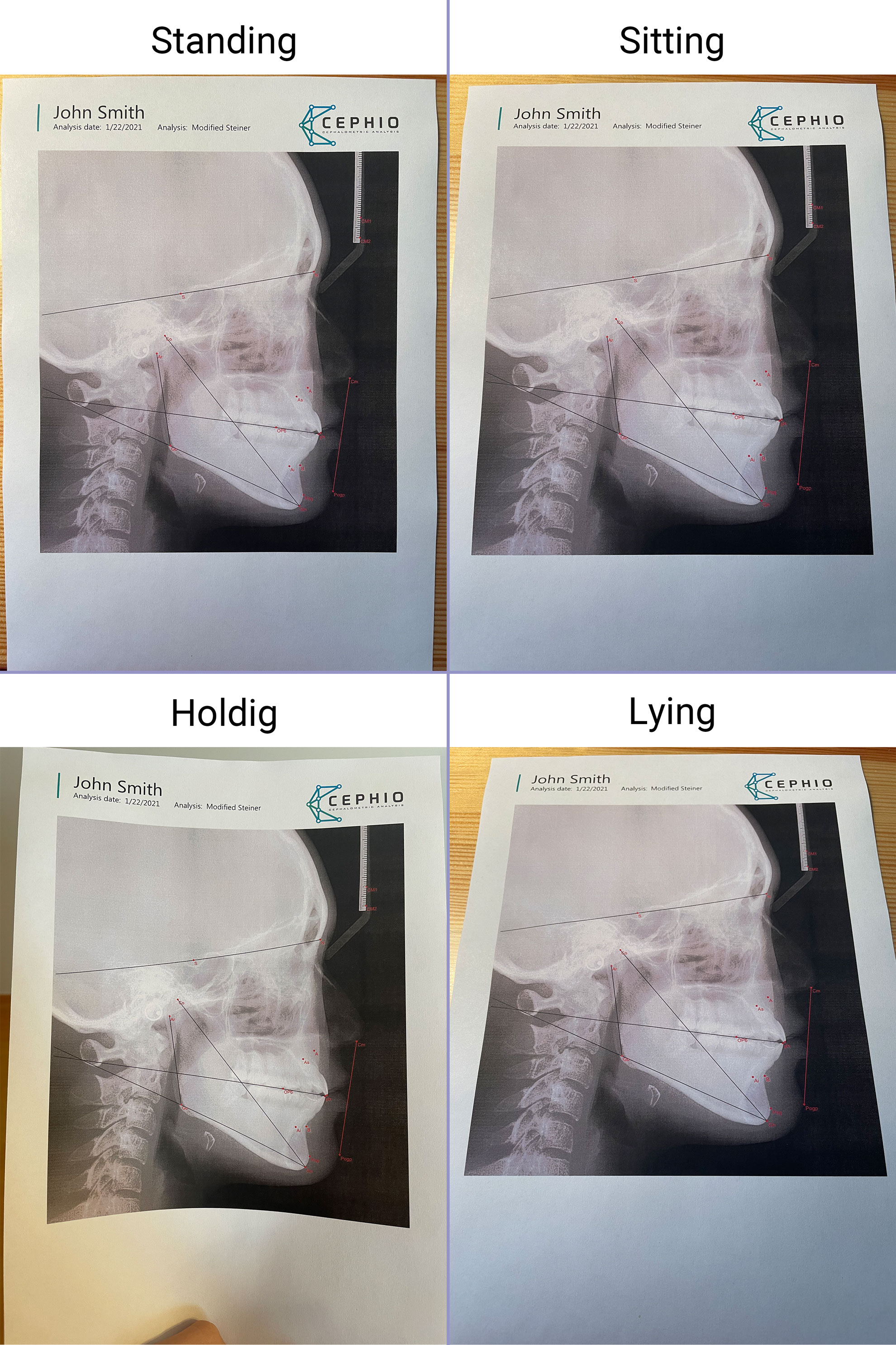 Pictures of cephalometric X-rays.