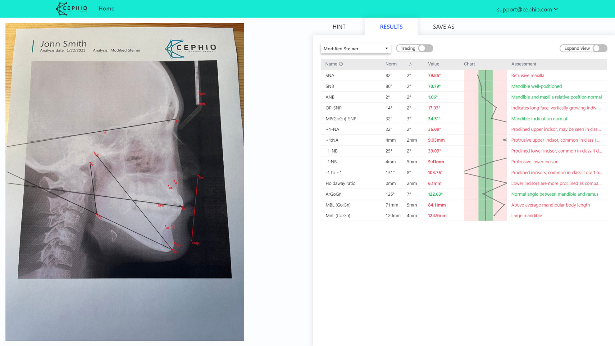 Steiner cephalometric analysis of an X-ray picture.